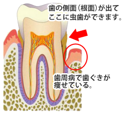 根面虫歯のメカニズム