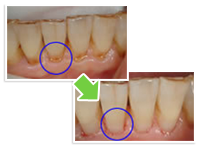 根面虫歯の予防